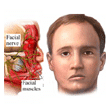 bells-palsy